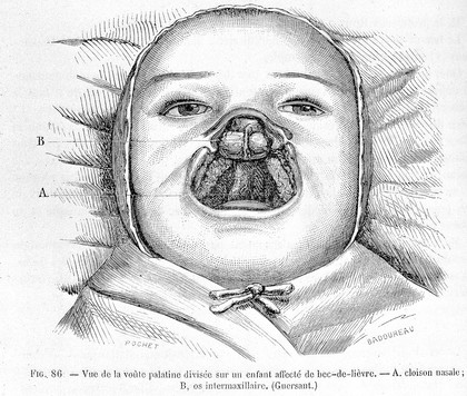 Infant with cleft palate and cleft lip. 19th Century.