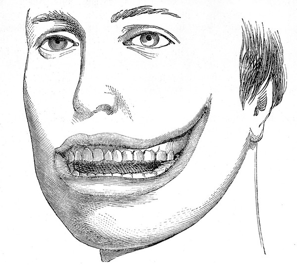 Child welfare: Operation for hare lip & cleft palate