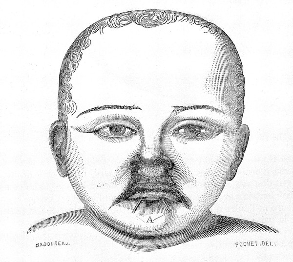 Child welfare: Operation for hair lip and cleft palate.