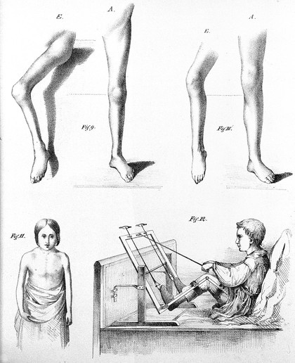 Beobachtungen über Lähmungszustände der untern Extremitäten und deren Behandlung / Von J. Heine.