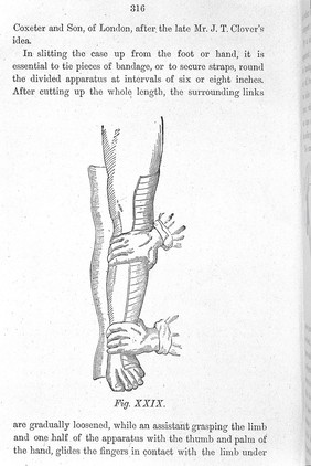 On the treatment of wounds and fractures : clinical lectures / by Sampson Gamgee.