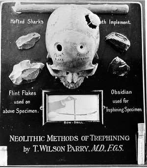 view Neolithic methods of trephining by T. Wilson Parry, from the slide collection of T. Wilson Parry, No. 3977