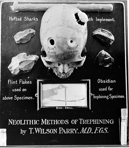 Neolithic methods of trephining by T. Wilson Parry, from the slide collection of T. Wilson Parry, No. 3977