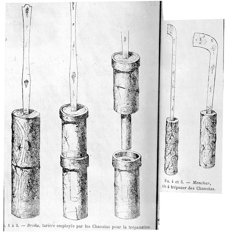 Primitive surgical instruments used by the Chaoulas, from the