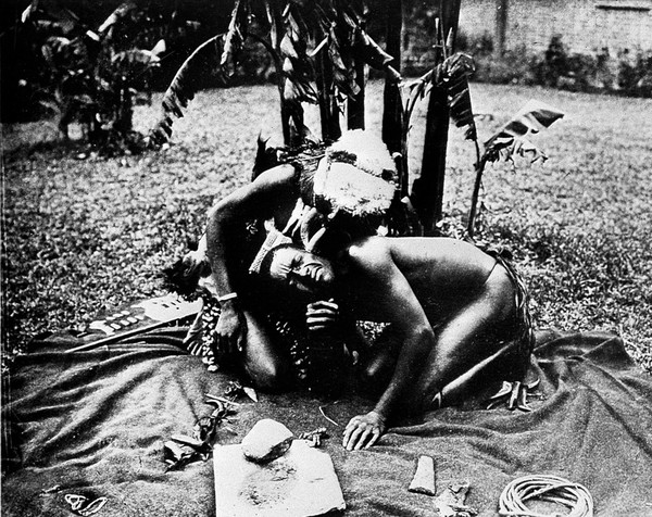 Kaffir medicine man cupping a patient