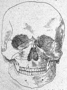 Skull illustrating Le Fort's Article.