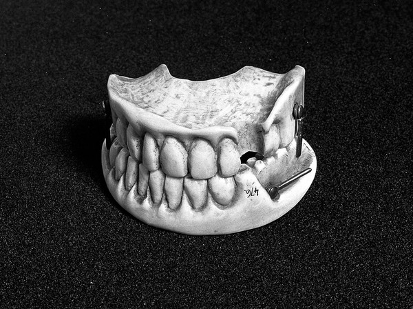 Carved ivory upper and lower denture