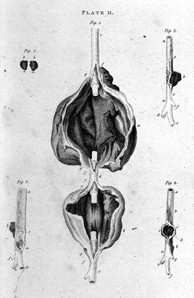 Scarpa "Aneurism", 1819: plate