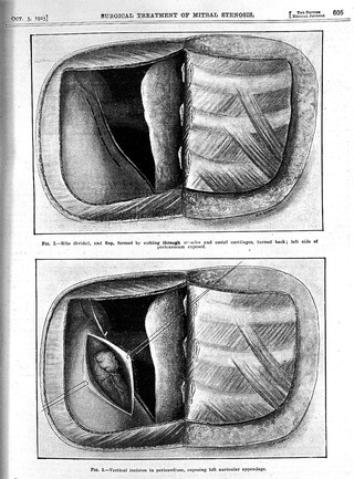 Surgical treatment of mitral stenosis, 1925