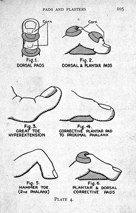 Chiropodical corrective pads.