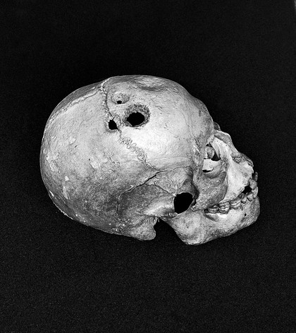 Trephined skullin showing different stages of healing