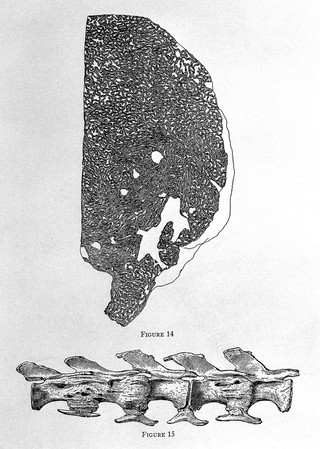 Dinosaur tumor and caudal vertebral from Moodie's Paleopathology