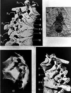 Neolitihc Pott's disease