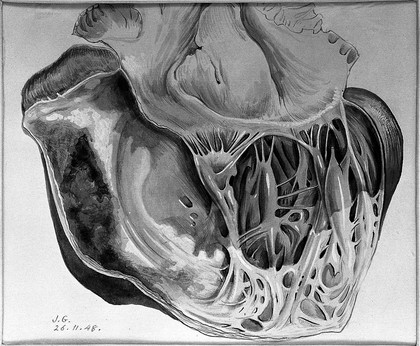 Cardiac infarct from a case.