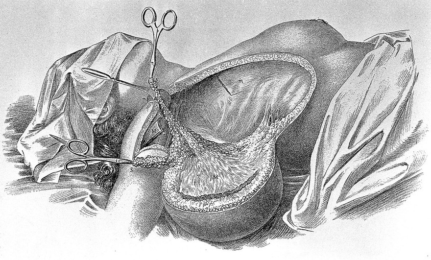 Surgical papers / by William Steward Halsted.