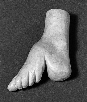 Cast of women's foot deformed by foot binding