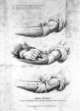 Three diagrams illustrating how to bleed an arm. Stipple engraving.