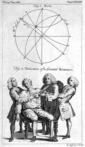 A surgeon and two assistants manipulating a dislocated shoulder joint back into the correct position. Etching by T. Jefferys.