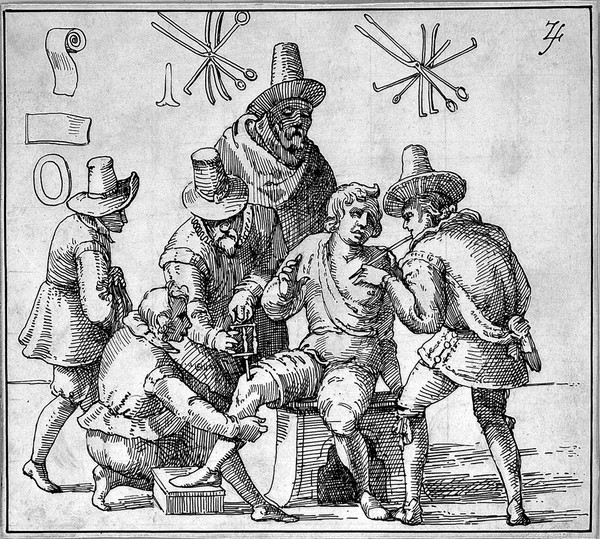 Two surgeons treating the same patient, one is removing an arrow from his chest whilst the other is boring a hole into the patient's knee accompanied by two assistants and an onlooker. Pen drawing by ZS.