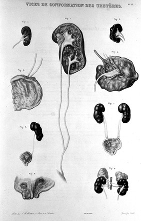 Traité des maladies des reins et des altérations de la sécrétion urinaire, étudiées en elles-mêmes et dans leurs rapports avec les maladies des uretères, de la vessie, de la prostate, de l'urèthre, etc. Avec un atlas in-folio / par P. Rayer ... Tome premier-[troisième].