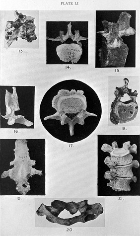 Egypt, Arthritis deformans and spondylitis.