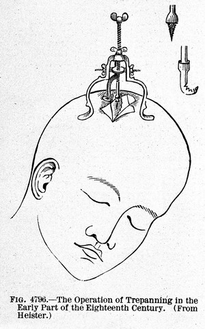 view Trephining, from Buck "Reference handbook...", 1904