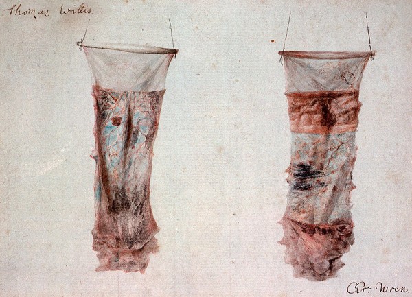 A piece of small intestine showing typhoid lesions: two figures. Watercolour.