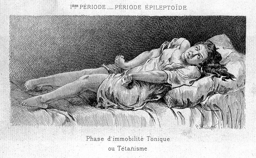 Études cliniques sur l'hystéro-épilepsie ou grande hystérie / par Paul Richer ; précédé d'une lettre-préface de J.-M. Charcot.