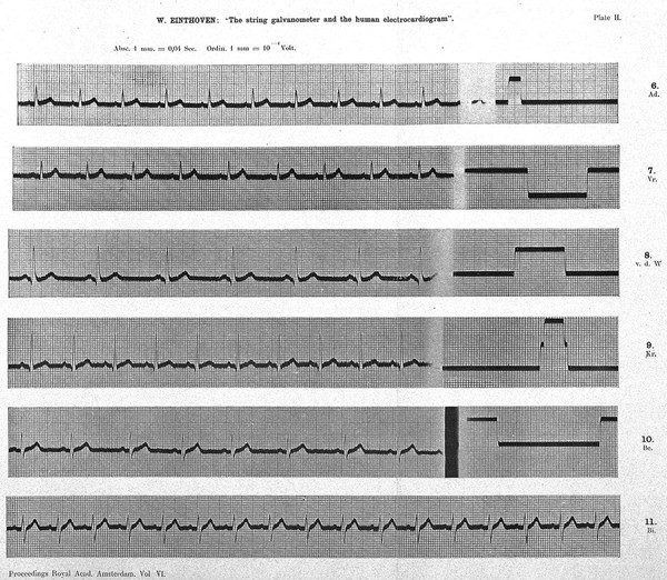 The string galvanometer and the human electrocardiogram / by W. Einthoven.