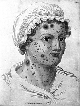 Delineations of cutaneous diseases: exhibiting the characteristic appearances of the principal genera and species comprised in the classification of the late Dr. Willan; and completing the series of engravings begun by that author / [Thomas Bateman].
