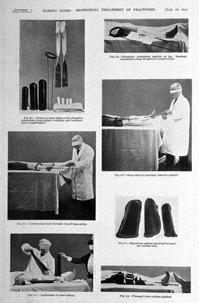 Mechanical treatment for fractures