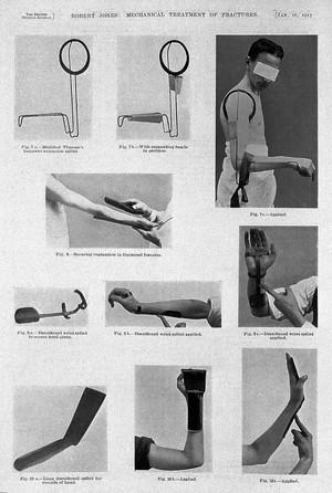 view Mechanical treatment for fractures