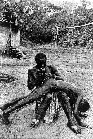 view Administration of an enema, Ivory Coast, Africa. From a photograph in the possession of Dr. Bockbank.