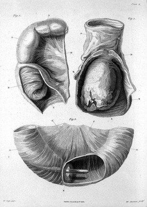 view Matthew Baillie, a series of engravings