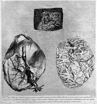 Anatomia uteri humani gravidi tabulis illustrata ... The anatomy of the human gravid uteris exhibited in figures / [William Hunter].