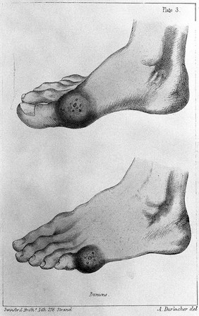 A treatise on corns, bunions, the diseases of nails, and the general management of the feet / By Lewis Durlacher.