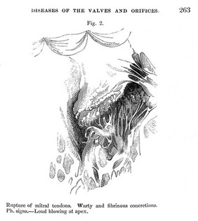 C.J.B. Williams, 1840: rupture of mitral valve