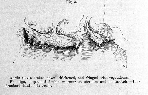 C.J.B. Williams, 1840: aortic valves