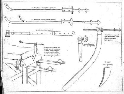 Instruments of lithotripsy from Heurteloup, Lithotripsie. Memoirs sur la lithotripsie par percussion, 1833