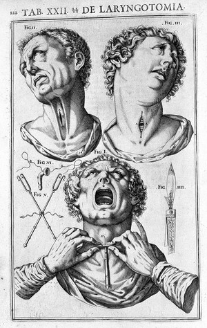 view Tracheotomy from Casserius, De Vocis Auditusque Organis...