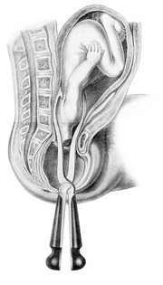 Elements of operative midwifery ; comprising a description of certain new and improved powers for assisting difficult and dangerous labours; illustrated by plates: with cautionary strictures on the improper use of instruments / By David D. Davis.