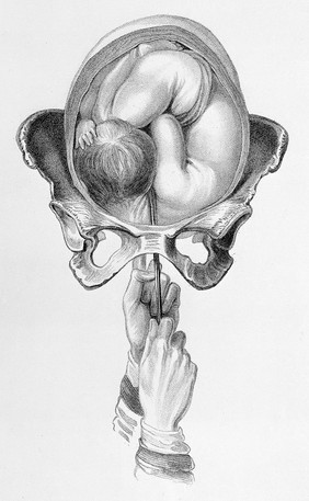 The principles and practice of obstetric medicine and surgery, in reference to the process of parturition / [Francis H. Ramsbotham].