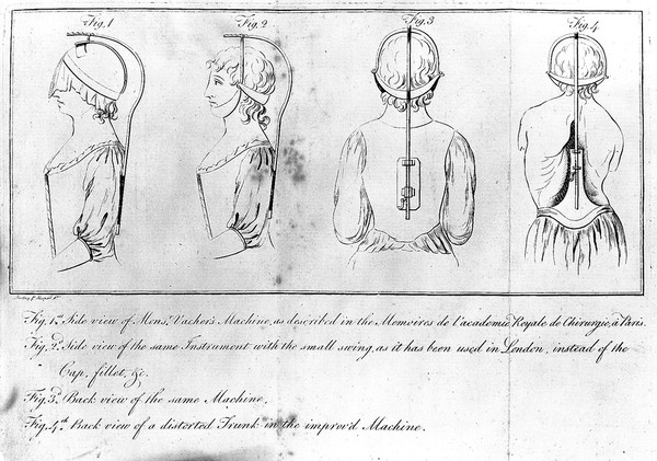An essay on the various causes and effects of the distorted spine; on the improper methods ... to remove that distortion; in which that recommended by Mr. Pott is considered, and the bad effects of Vacher's ( ... called Jones's) spinal machine are pointed out: with the description of an instrument ... better calculated to remove those distortions than any hitherto ... To which are added, some observations on ... ruptures / [Timothy Sheldrake].