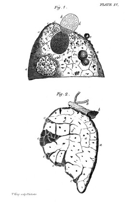 A treatise on the diseases of the chest and on mediate auscultation / by R.T.H. Laennec. Translated from the latest French edition / with notes and a sketch of the author's life / by John Forbes.