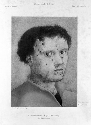 A young man with an ulcerated face. Lithograph after H. Holbein.