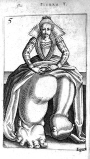 Girl with Elephantiasis from De Hermaphroditorum, 1614