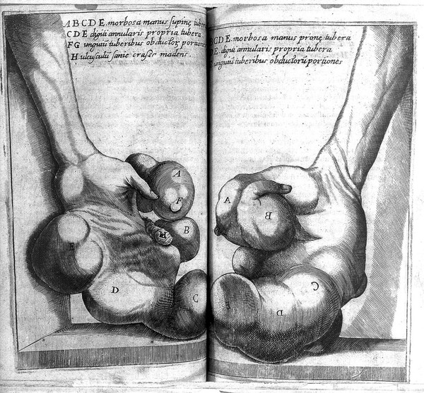 De recondita abscessuum natura libri VII / [Marco Aurelio Severino].