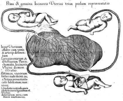 Observatio anatom.-medica singularis mulieris cuiusdam calend. Januarii A*1 M.DCXLIV. tres filios naturalis magnitudinis viventes enixae. Puerpera vero retentis secundinis, extremum quasi halitum spirabat...foeliciter evasit / [Michael Rupert Besler].