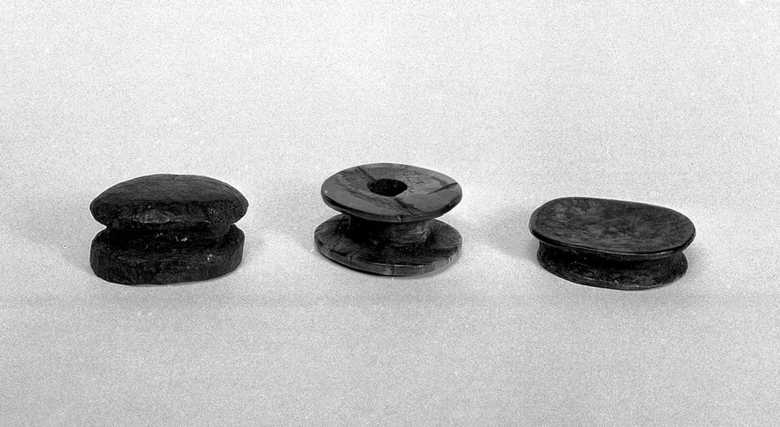 Artificial deformation, 2 Labrets (lip plugs), 1 lip stud