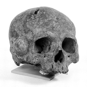 view Deformation, skull showing fronto-occipital flattening